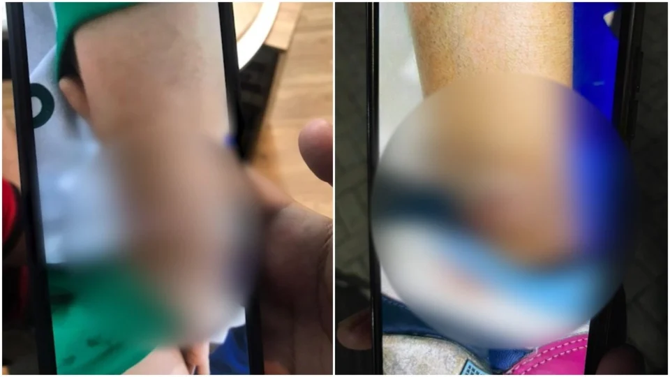 VÍDEO: criança vai à escola com sinais de violência e autoridades são acionadas