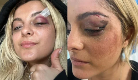 Bebe Rexha mostra hematoma após ser atingida por celular em show nos EUA