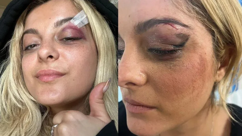 Bebe Rexha mostra hematoma após ser atingida por celular em show nos EUA