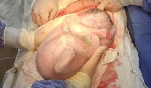 Bebê nasce empelicada em saco gestacional através de cesariana em Iporá-GO