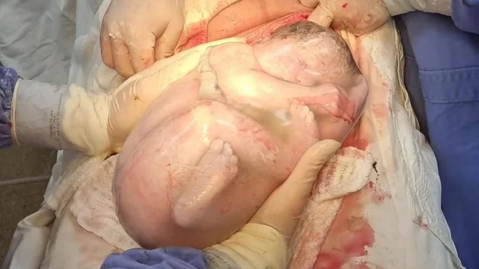 Bebê nasce empelicada em saco gestacional através de cesariana em Iporá-GO