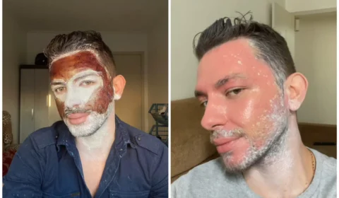 VÍDEO: homem exibe rosto descamando após ação de peeling de fenol; assista