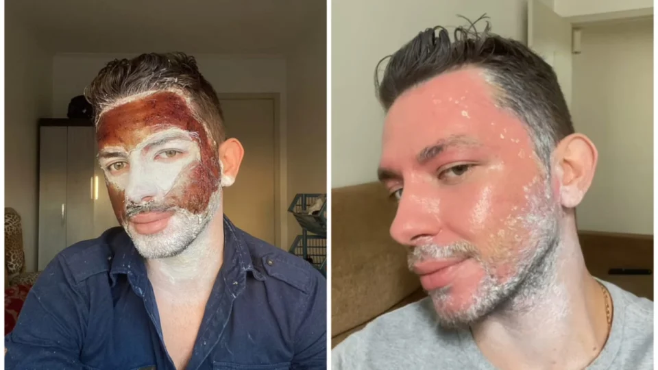 VÍDEO: homem exibe rosto descamando após ação de peeling de fenol; assista