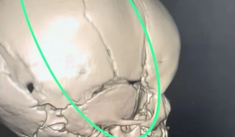 Bebê fratura crânio após cair de incubadora na Maternidade de RR