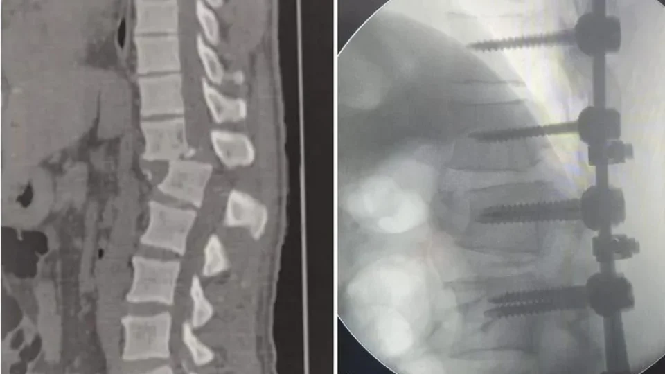 Veja antes e depois da cirurgia do homem atingido por aparelho de academia