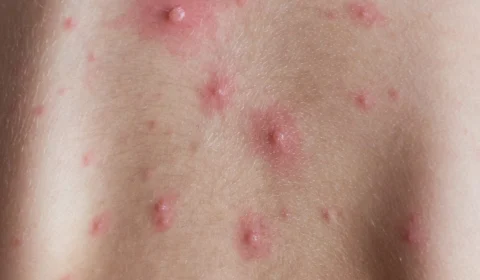 Saúde reforça cuidados contra catapora durante estiagem no Acre