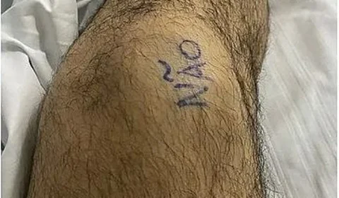 Paciente escreve ‘sim’ e ‘não’ nos joelhos para marcar antes de cirurgia