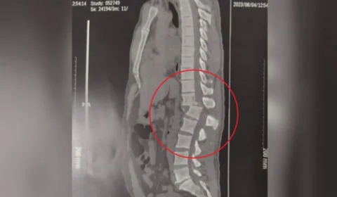 Exame mostra que homem que sofreu acidente em academia teve coluna deslocada no CE