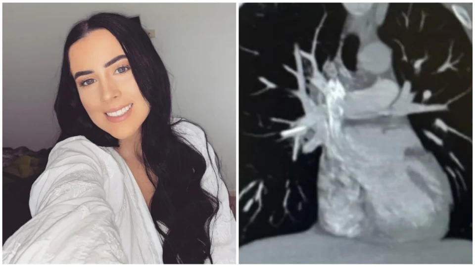 Jovem australiana retira implante contraceptivo que migrou para coração; veja