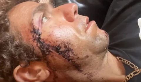 Surfista recebe mordida de tubarão no rosto em praia da Flórida-EUA