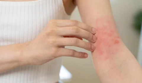 Mesmo sem casos registrados, médicos alertam sobre esporotricose no Acre