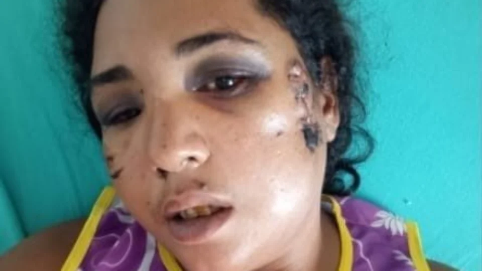 Vítima de tiro na cabeça pelo marido faz campanha para custear cirurgia no Acre