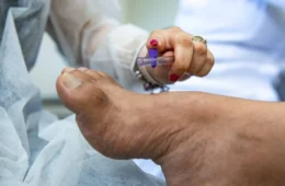 Tocantins registra alta nos casos de hanseníase, divulga SES