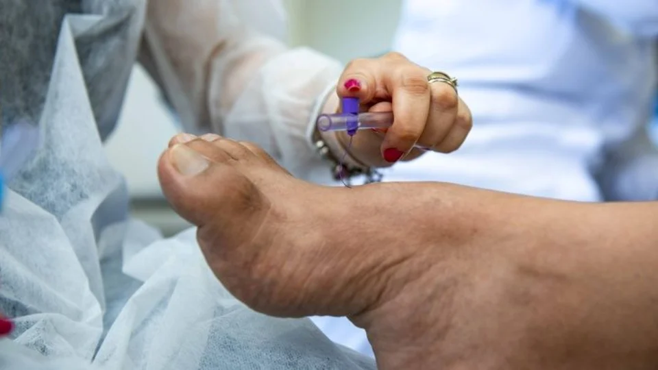 Tocantins registra alta nos casos de hanseníase, divulga SES