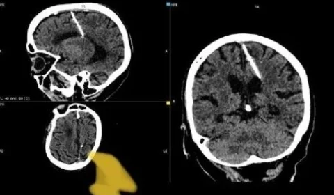 Idosa acha agulha de 3cm no cérebro após realizar exames na Rússia