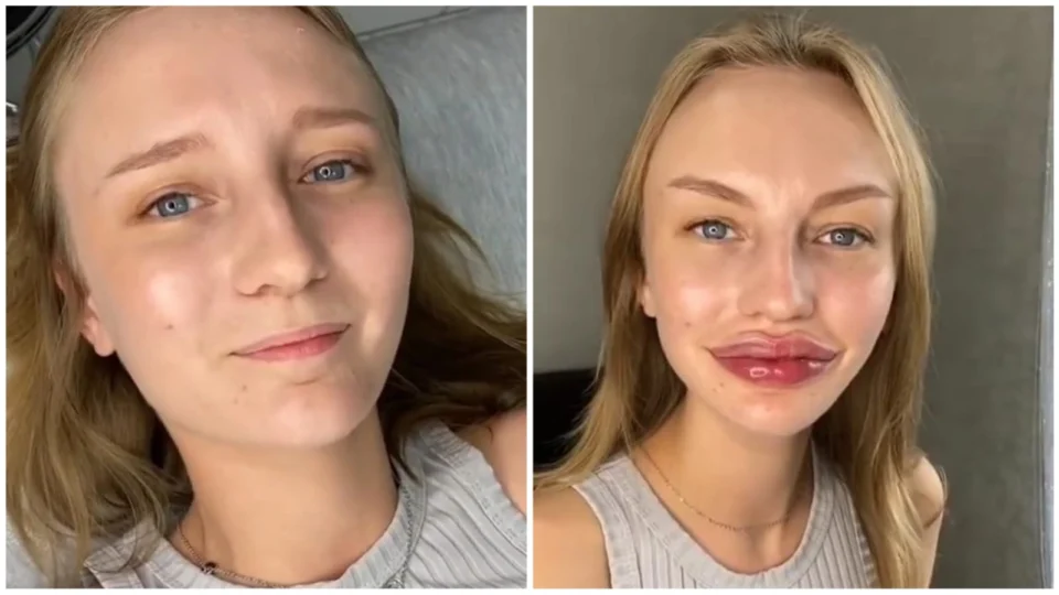 Resultado de preenchimento labial surpreende internautas; confira