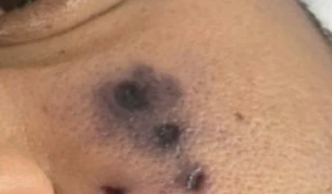 Caso Darlyn: especialista alerta sobre ataques de aranhas peçonhentas em TO