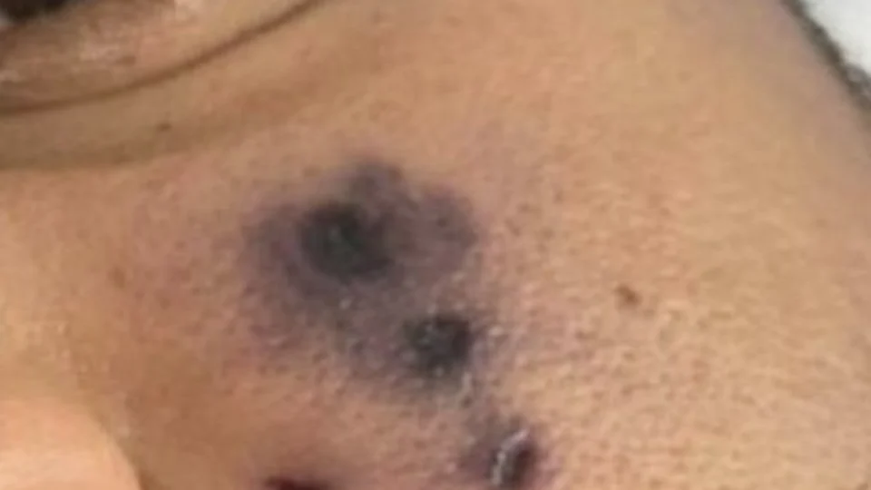 Caso Darlyn: especialista alerta sobre ataques de aranhas peçonhentas em TO