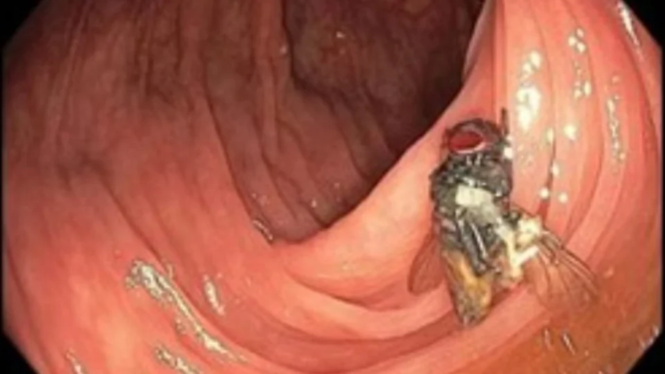 Paciente de 63 anos faz exame e descobre mosca intacta no intestino