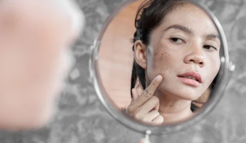 Melasma: condição afeta cerca de 35% da população feminina do Brasil