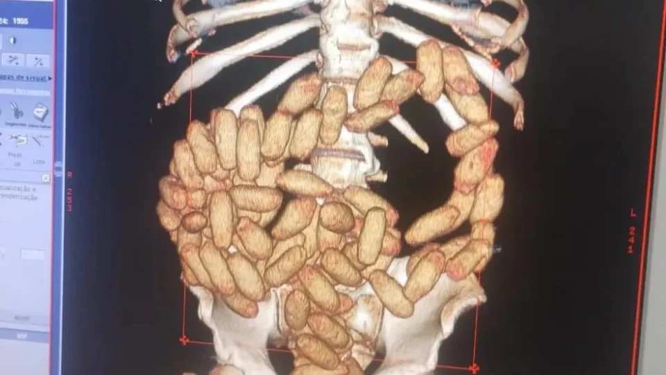 Raio-x mostra cápsulas de cocaína no estômago de 6 passageiros em SP