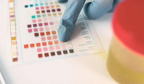 AM tem 102 notificações de rabdomiólise; 68 casos são confirmados