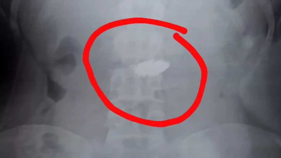 Adolescente engole corrente de R$ 10 mil após furto e objeto fica preso