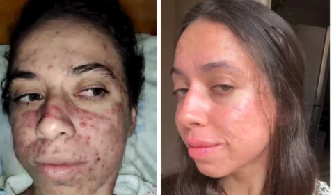 Acne Severa: influenciadora viraliza após mostrar realidade com a pele; veja vídeo