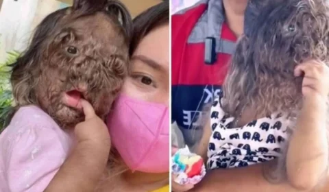 Menina de 2 anos sofre de ‘síndrome de Lobisomem’; entenda