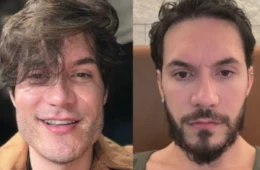 Eliezer reverte harmonização após se chocar com foto: “Caí na real”