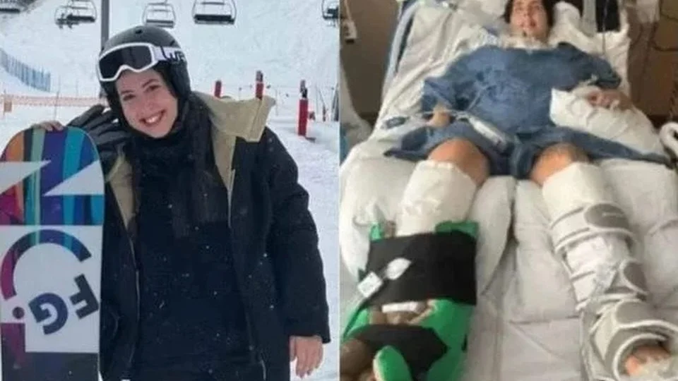 O que se sabe sobre a brasileira paralisada após botulismo? Confira