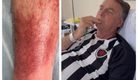 Erisipela: entenda a doença que afeta Jair Bolsonaro