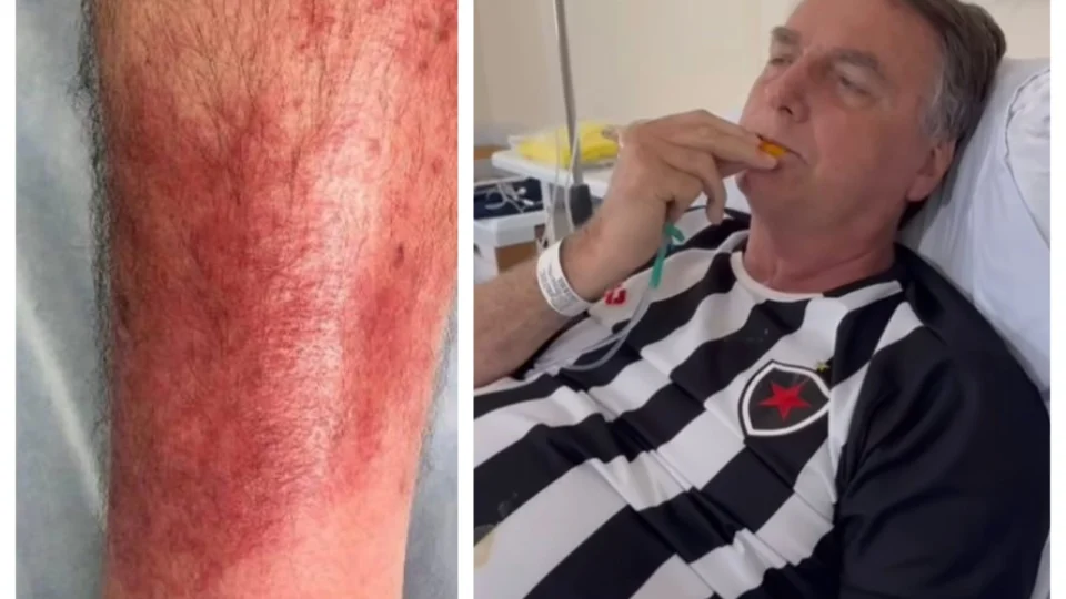 Erisipela: entenda a doença que afeta Jair Bolsonaro