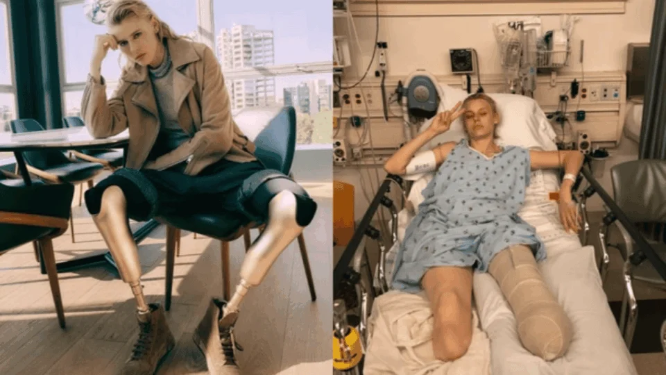 Modelo tem pernas amputadas após uso de absorvente interno