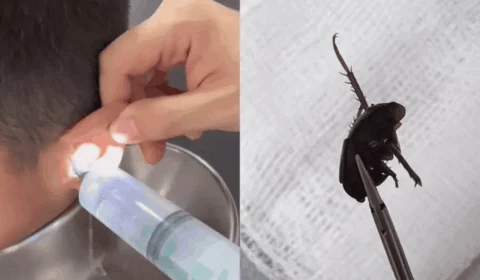 VÍDEO: médico tira barata e pedaços de frutas do ouvido de criança