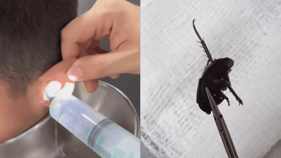 VÍDEO: médico tira barata e pedaços de frutas do ouvido de criança