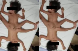 Médicos dão veredito sobre cirurgia de gêmeos siameses com 3 pernas