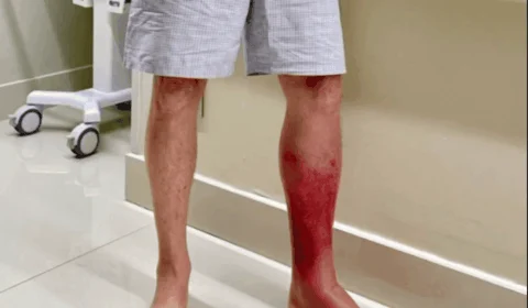 Entenda doença de pele que deixou ex-presidente internado