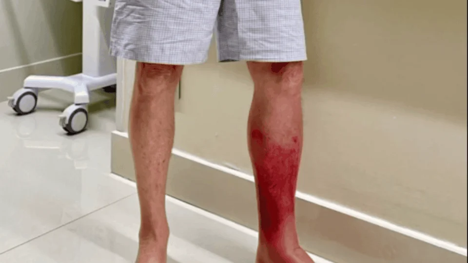 Entenda doença de pele que deixou ex-presidente internado