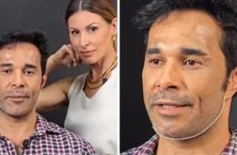 Web critica antes e depois de harmonização facial: ‘não precisava’