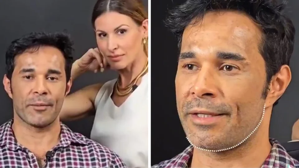 Web critica antes e depois de harmonização facial: ‘não precisava’