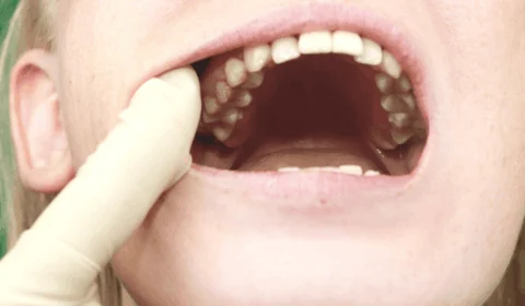 Câncer de boca cresce entre os mais jovens; entenda