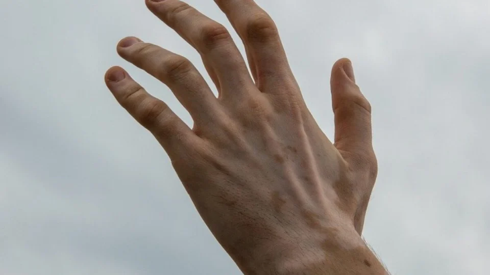 Dia Mundial do Vitiligo, 25 de junho: estigmas e desafios no Brasil
