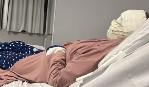 Após peeling de fenol, idosa tem queimaduras de terceiro grau