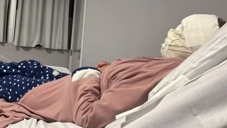 Após peeling de fenol, idosa tem queimaduras de terceiro grau