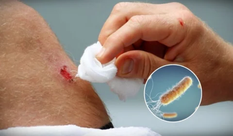 Bactéria ‘comedora de carne’; saiba mais sobre a infecção