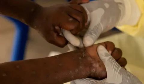 Mpox: Anvisa encontra imigrante com sintomas da doença em aeroporto; veja