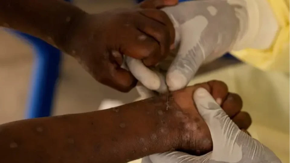 Mpox: Anvisa encontra imigrante com sintomas da doença em aeroporto; veja