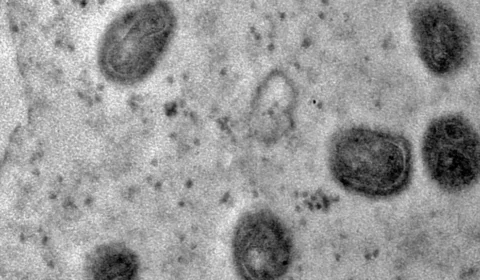 Mpox: doença não é a nova covid, afirma diretor da OMS; veja