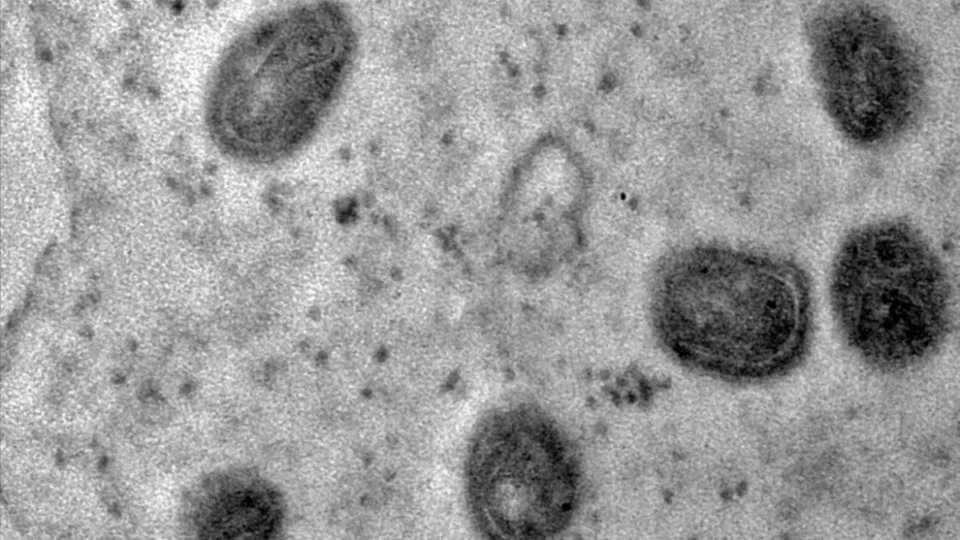 Mpox: doença não é a nova covid, afirma diretor da OMS; veja